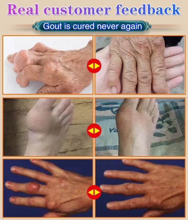 Last-Day Big Sale - Gout Relief Cream