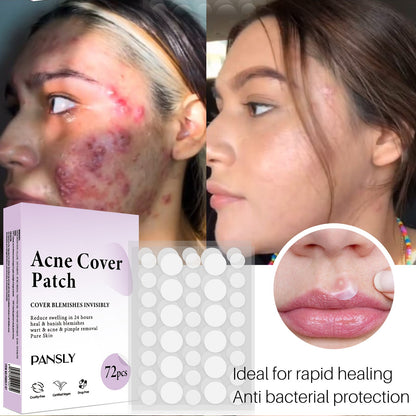 Acne Cover Patch (72PCS/Box)